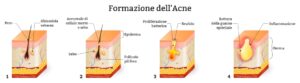 Acne formazione