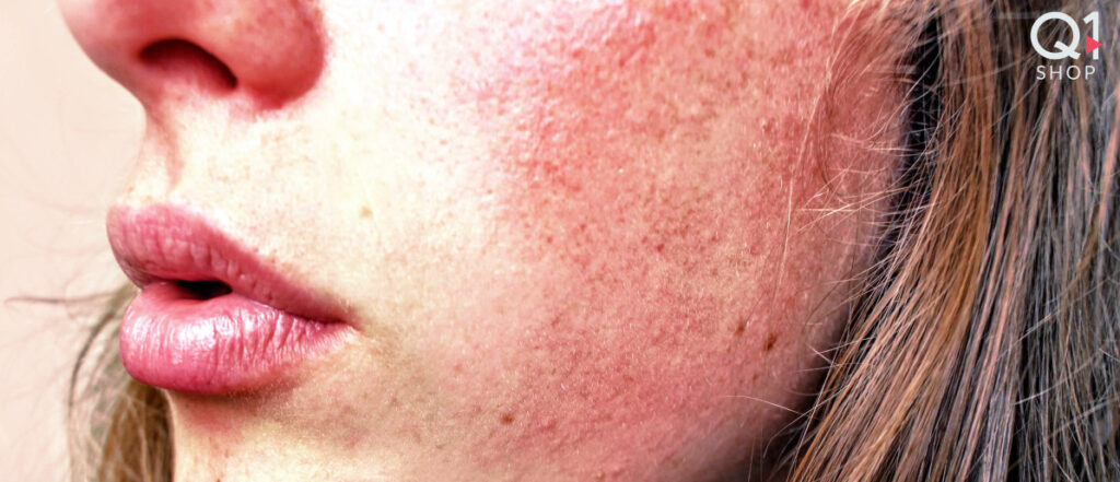 Crema lenitiva Arrossamenti ed irritazioni della pelle Q Protective