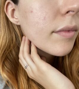 opinione q acne complex
