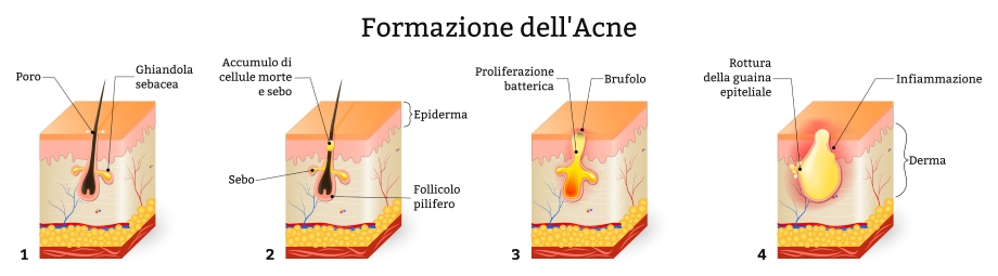 Acne formazione