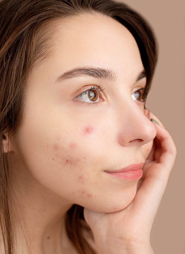 acne come combatterla