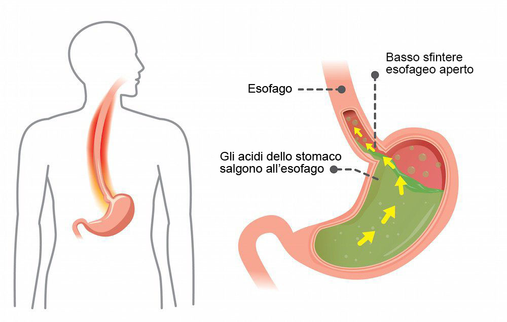 sintomi reflusso gastrico